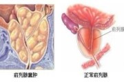 飞机打多了前列腺炎吃什么药