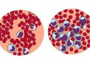 流鼻血怎么排除白血病 白血病早期的症状有哪些