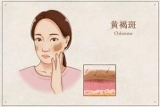 引起黄褐斑的原因有哪些 黄褐斑该如何治疗好