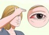 红眼病怎么预防 红眼病是怎么引起的