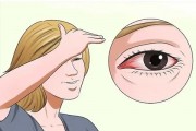 红眼病怎么预防 红眼病是怎么引起的