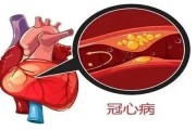 治冠心病最好的药是什么 冠心病是什么原因引起的